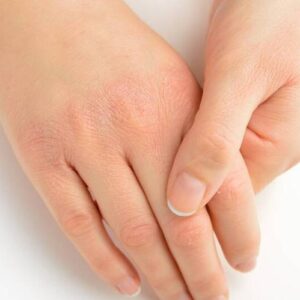 Penyakit Kulit Musim Hujan yang Harus Diwaspadai