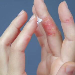 Salep Gatal Berair dan Menyebar, Pahami Apa Penyebabnya