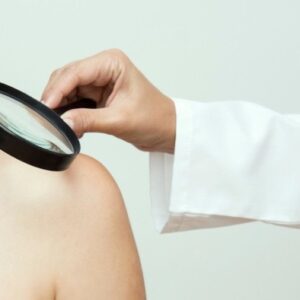 Gejala dan Penyebab Kanker Kulit, Kanker yang Paling Sering Terjadi!